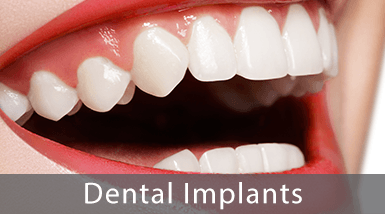 Dental Implants